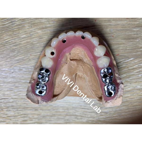 Quality Screwed Retained Hybrid Implant Supported Dentures High Accuracy for sale