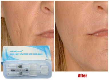 Quality Hyaluronic Acid Injectable Filler 10ml For Lip Injection Cheeks Chin Augmentation for sale