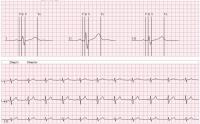 China Wecardio 3-Leads Cardiac Event Recorder Bluetooth ECG Monitor Mobile EKG Telemetry HRV factory