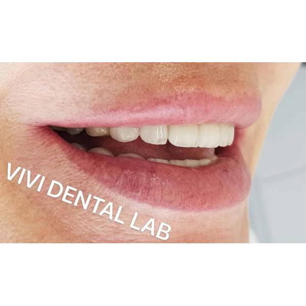 Quality Strong Dental Layered Zirconia Crowns Full Mouth FDA ISO Certificated for sale