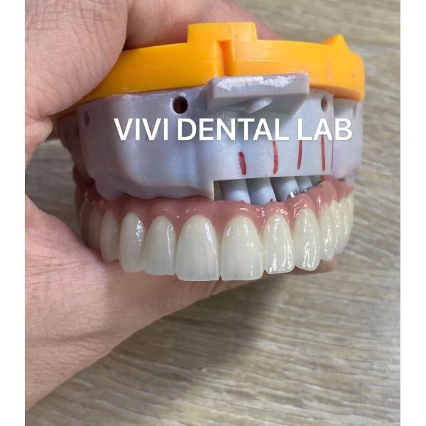 Alloy Dental Implant Supported Crowns Implants And Bridges Digital from China Factory