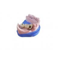 Quality CAD CAM Zirconia Dental Crown With Titanium Base Zirconia Abutment for sale