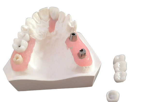 Quality FDA All Zirconia Crown with Implant-Supported Dentures for Dental Lab for sale