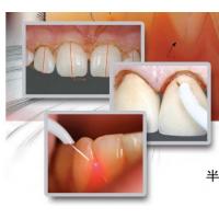 China Dental Tooth Whitening Machine dental laser teeth whitening factory