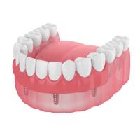 China Dentures Missing Teeth Dental Implant Bar Fillings Dentures Temporary Removable Dentures factory