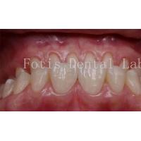China 0.3-0.5mm Thickness Cosmetic Teeth Covers Veneers For Cosmetic Dentistry factory